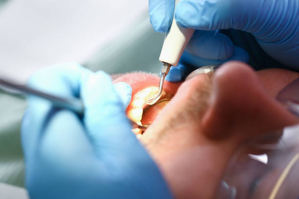 Best Emergency Root Canal Treatment in Addis, LA